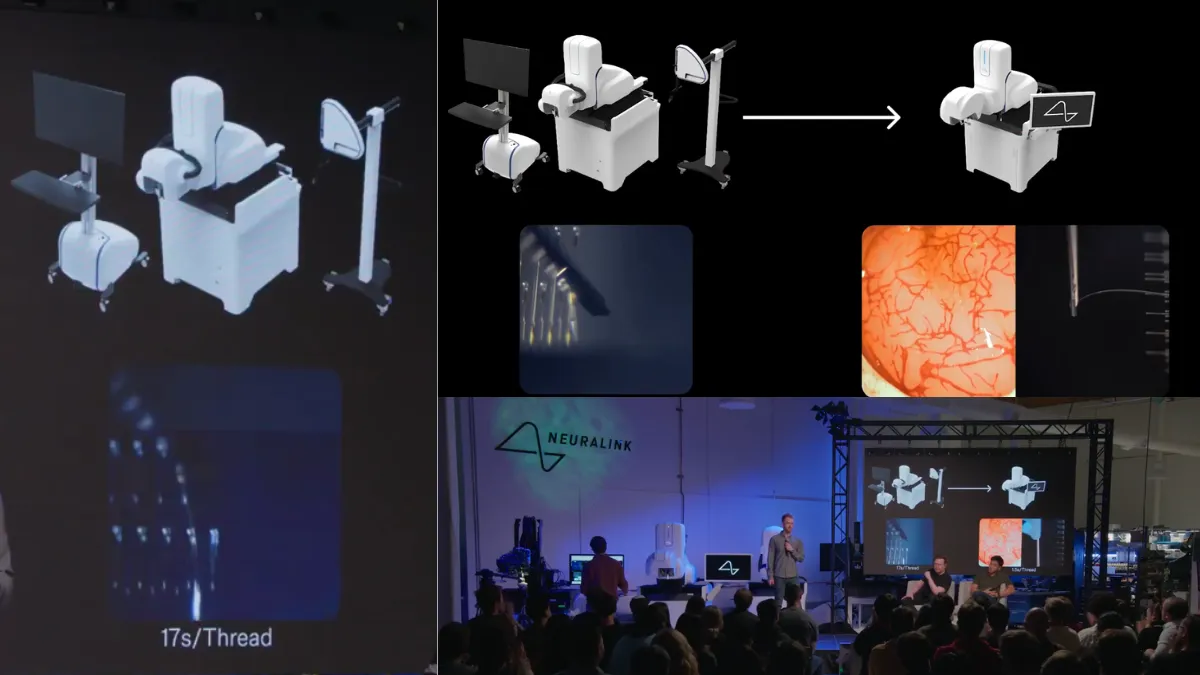 Neuralink का अगला कदम: अब 17 सेकंड की सर्जरी सिर्फ 1.5 सेकंड में!